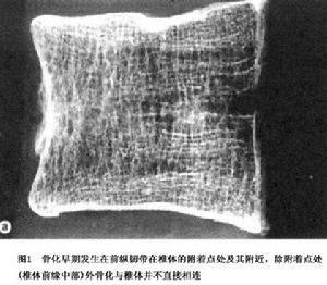 瀰漫性特發性骨肥厚