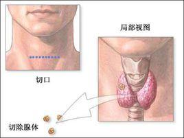 甲狀旁腺切除