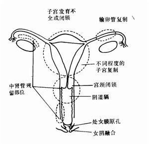 （圖）女性生殖器官發育異常部位