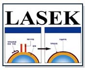 準分子角膜切削術