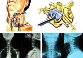 頸椎病前路減壓術