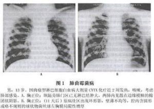 小兒真菌性肺炎