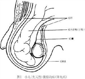 小兒腹股溝斜疝