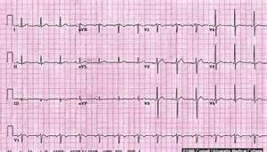 正常心電圖