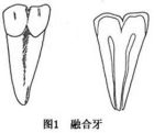 融合牙