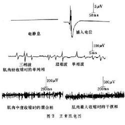 肌電圖