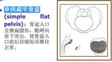 狹窄骨盆