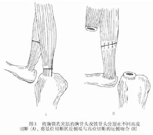 先天性斜頸