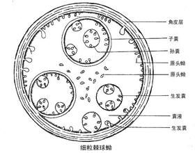 棘球蚴