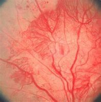 視網膜毛細血管瘤