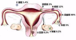 子宮脫垂懸吊術