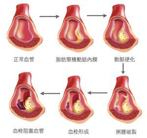 血栓形成過程