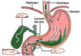膽汁反流
