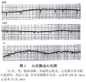 小兒心房顫動