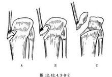 脛骨結節撕脫骨折切開復位術