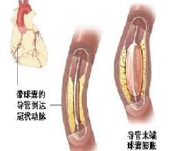 經皮腔內冠狀動脈成形術