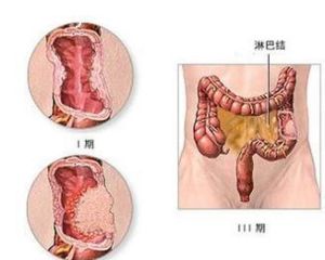 左半結腸癌