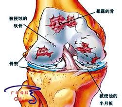 膝關節病