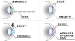 近視矯正手術