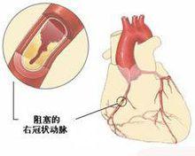 無症狀冠心病