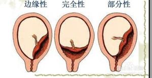 完全性前置胎盤