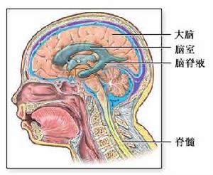 正常壓力腦積水