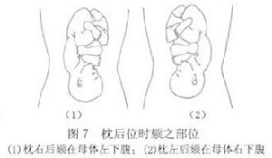 持續性枕後位難產