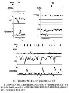 環咽肌失弛緩症