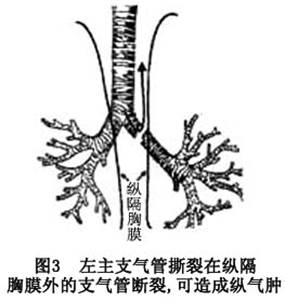 創傷性氣管及主支氣管損傷