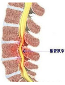 腰椎椎管狹窄症