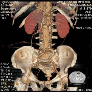 （圖）腎動脈瘤