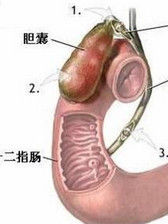 疣狀胃炎