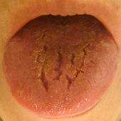 裂溝舌