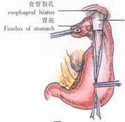 示意圖13:將胃底包繞食管下端一周