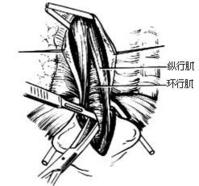 示意圖3:將環行肌仔細切