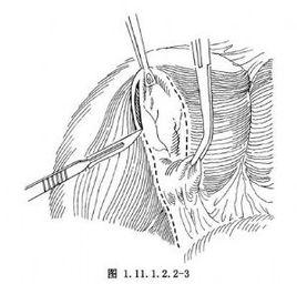 逆行膽囊切除術