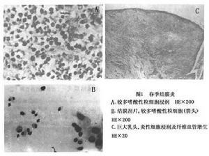 變態反應性結膜炎