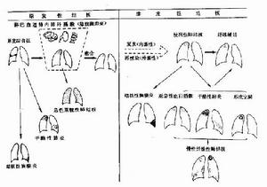 髖關節結核