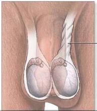 小兒睪丸鞘膜積液