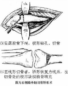 膝內翻切骨術