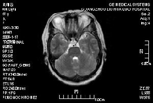 腔隙性腦梗死