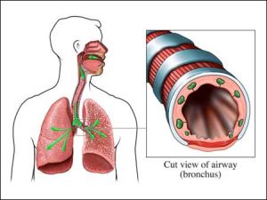 支氣管炎治療