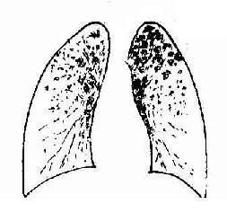 血行播散型肺結核