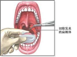 扁桃體摘除術