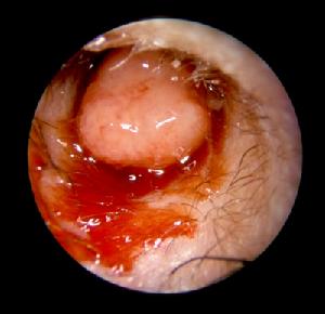 中耳膽脂瘤