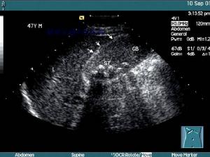 妊娠合併急性膽囊炎