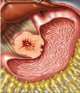 胃腸間質瘤