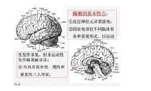 老年性癲癇