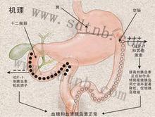 胃腸轉流術原理