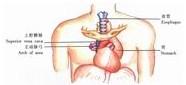 示意圖9:將胃底經左胸腔提至左頸部切口